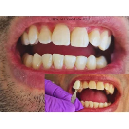 Clareamento Dental